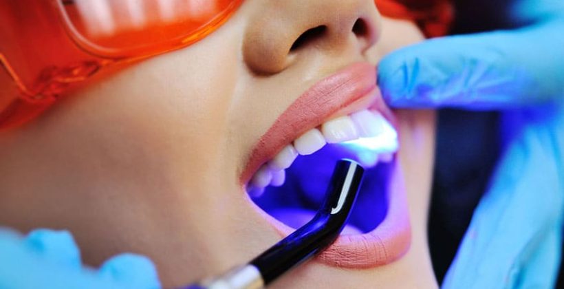 Kompozit Dolgu (Bonding)