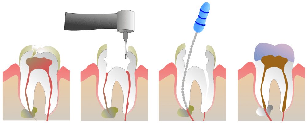 endodonti izmir