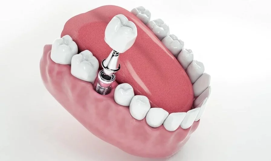 dental implant diş