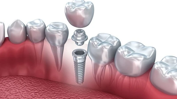 İzmir implant tavsiye diş hekimi