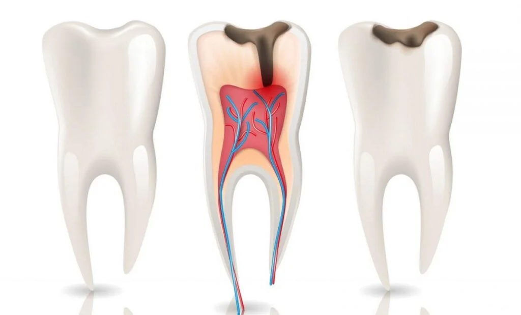 İzmir kanal tedavisi