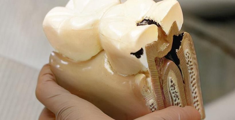 Diş Kökü İltihabı