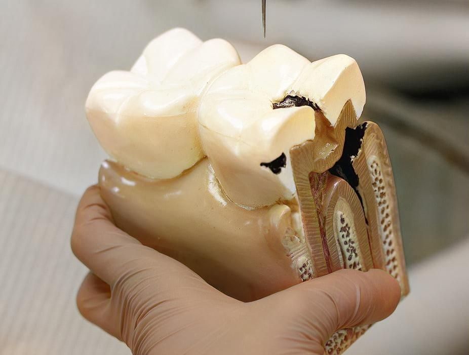 diş kökü iltihabı doğal yöntemler