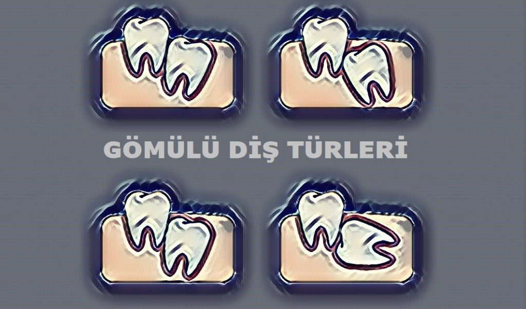 gömülü diş