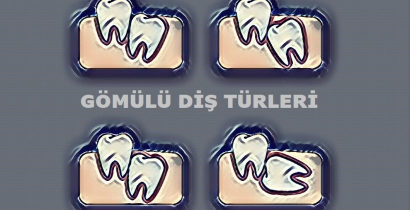 Gömülü Diş Çekimi