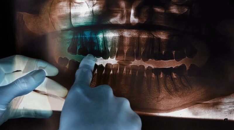 çene kemiği erimesi