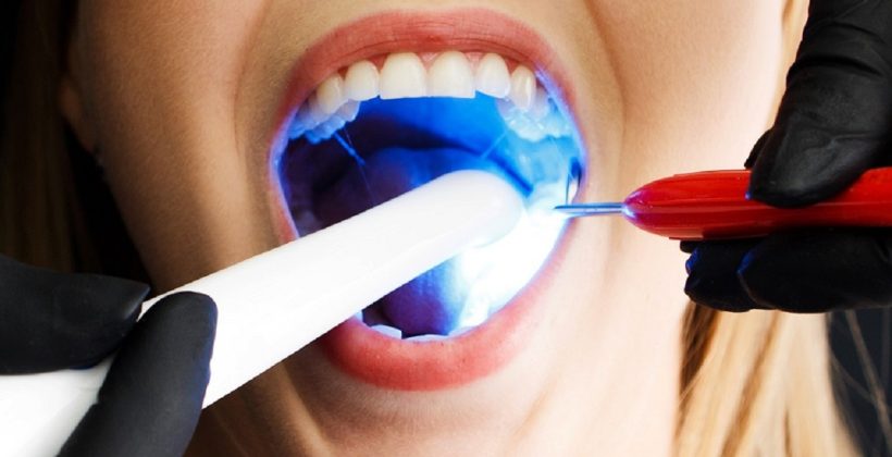 Dişlerde Oluşan Siyah Lekeler