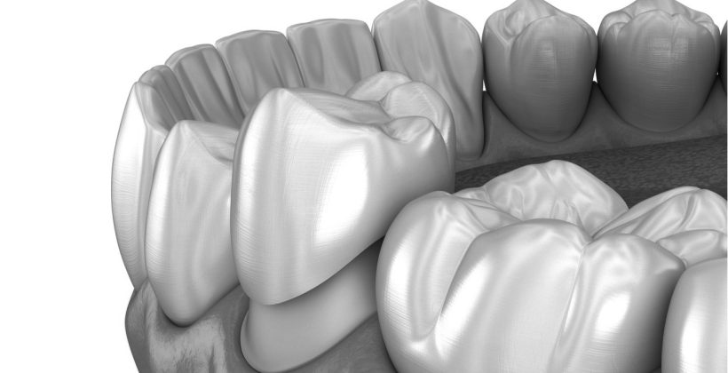 Kaplama Diş Düşmesi