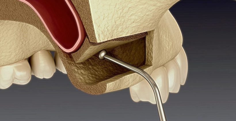Sinus Lifting Ameliyatı
