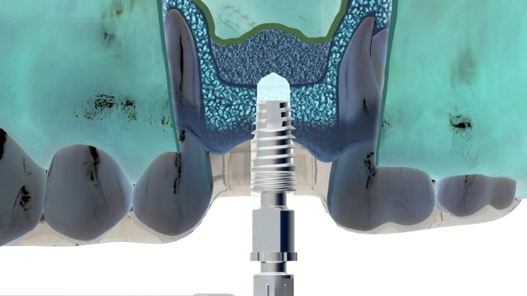 sinüs lifting ameliyatı