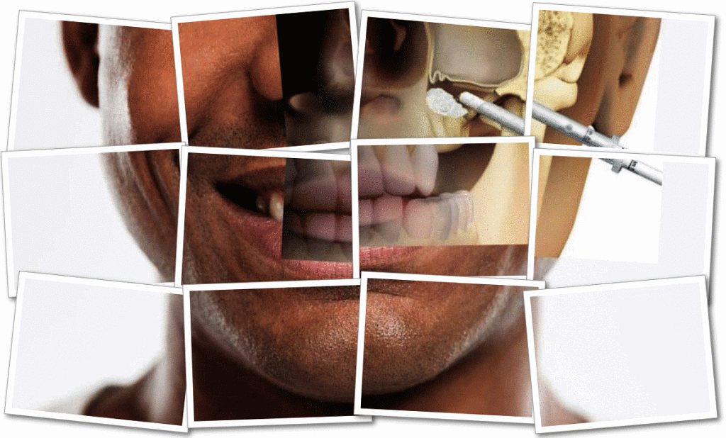 sinus lifting riskleri