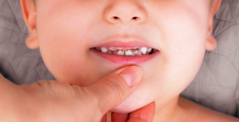 Bebeklerde Biberon Çürüğü