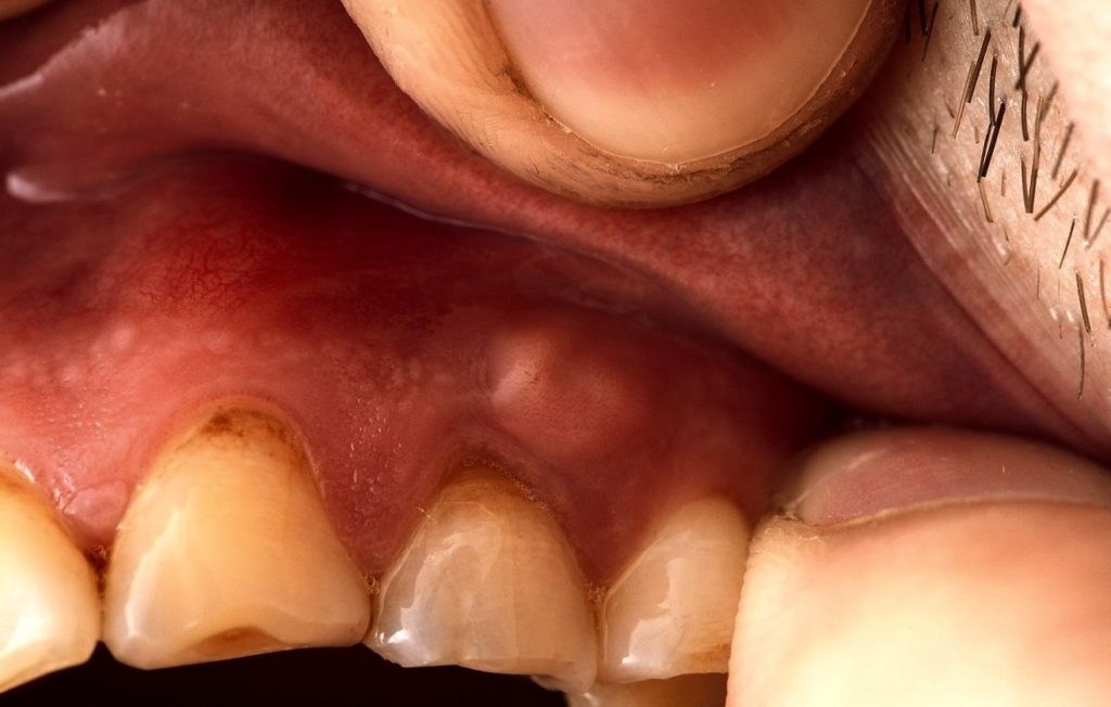 diş apsesinin belirtileri