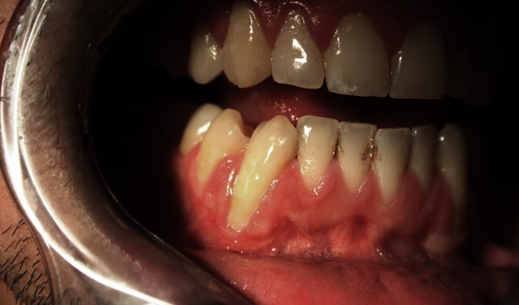 diş eti çekilmesi nasıl olur