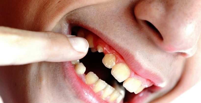 Kırık Diş Tedavisi