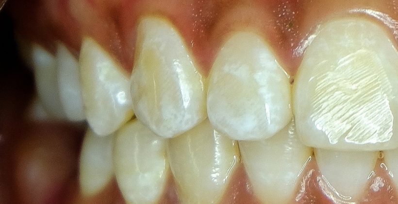 Florozis Nedir? Florozis Nedir?