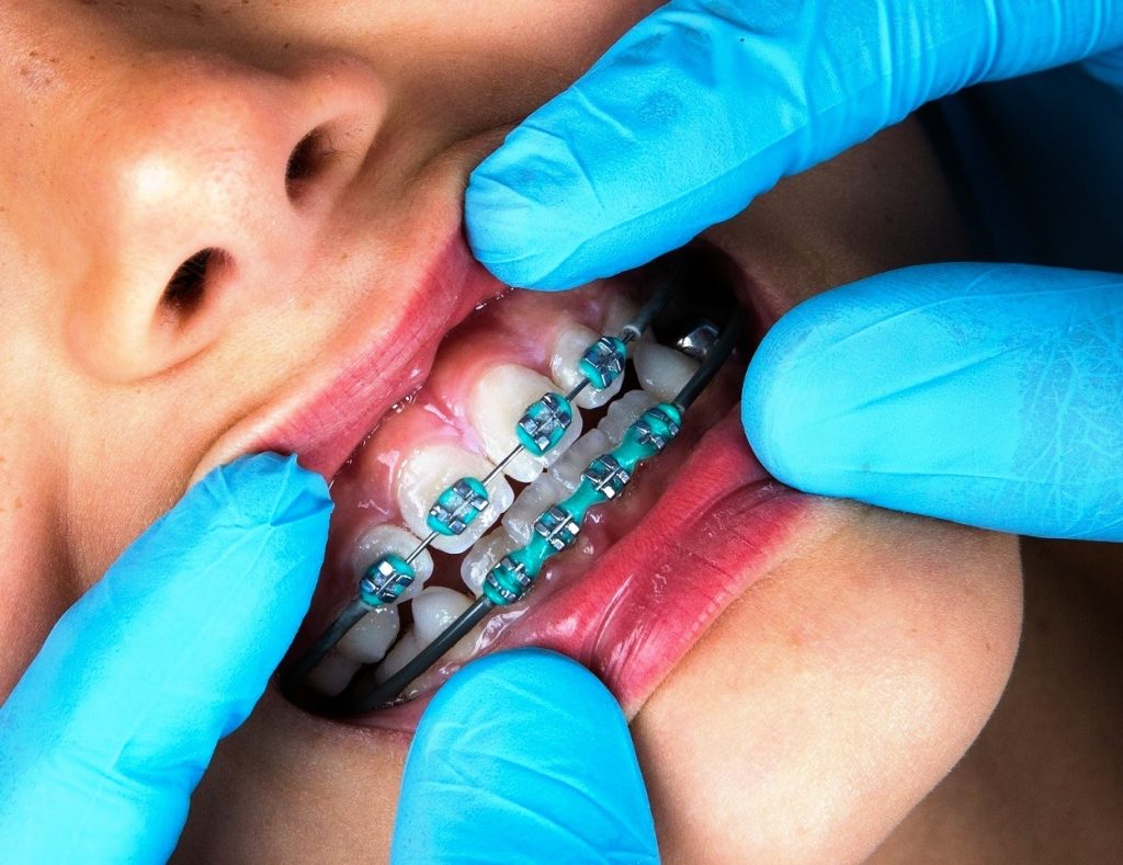 ortodontik tedavi yontemleri