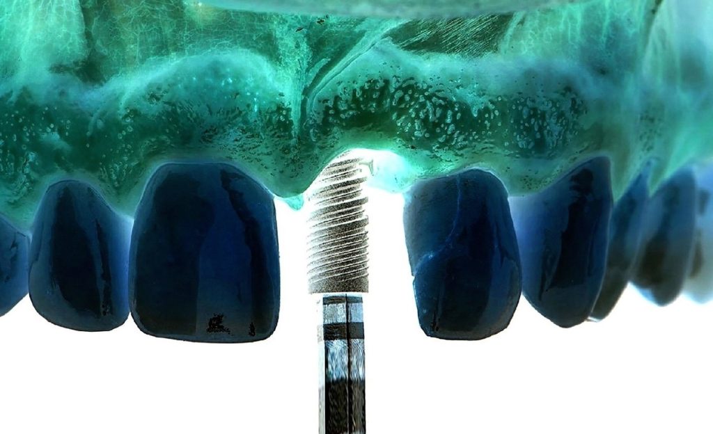 zigomatik implant nedir