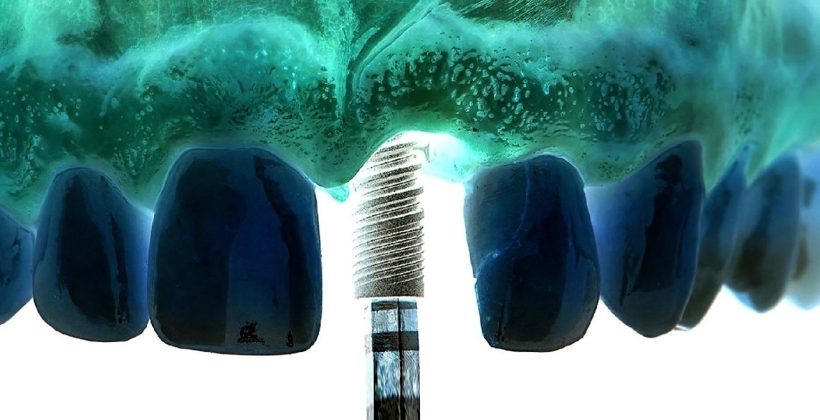 Zigomatik implant Nedir?