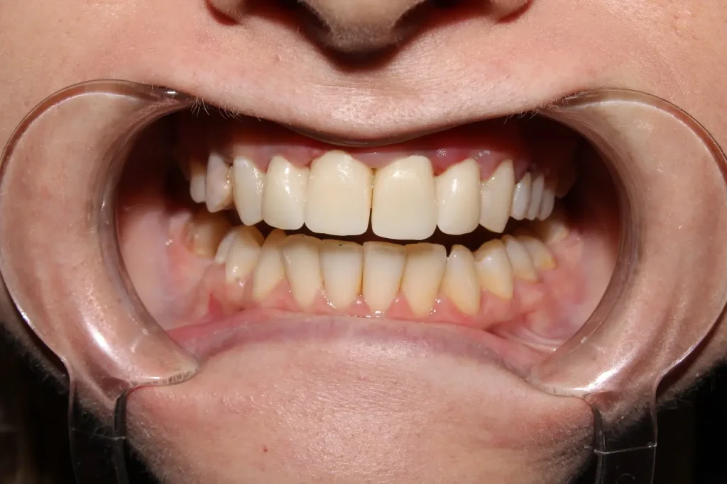 Alt ve Üst Dişlerin Kapanmaması