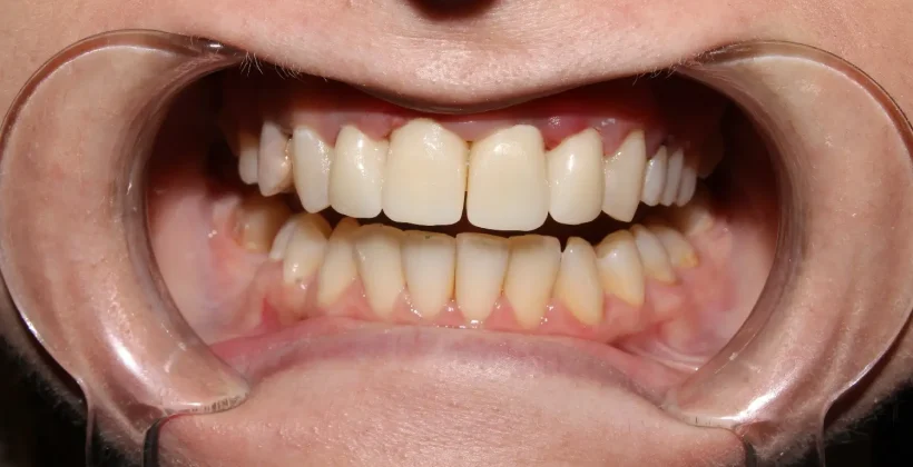 Alt ve Üst Dişlerin Kapanmaması Alt ve Üst Dişlerin Kapanmaması