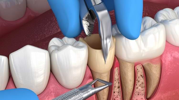20’lik Dişler Ne Zaman Çekilmeli? 20’lik Dişler Ne Zaman Çekilmeli?