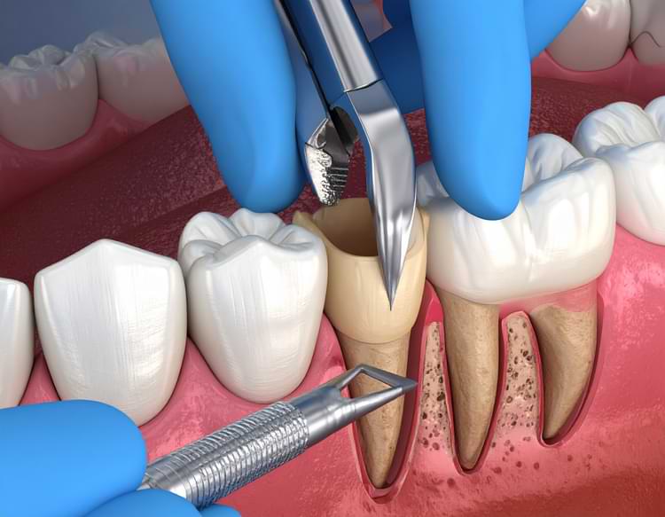 20’lik Dişler Çekilmeli Mi?