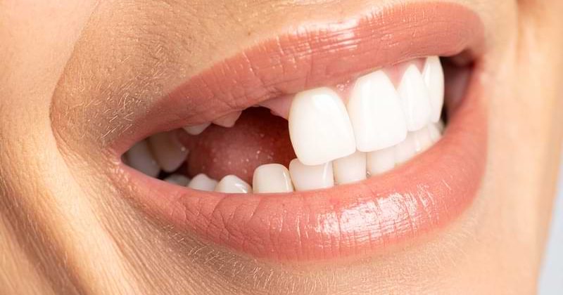 Diş Eksikliği Hangi Sorunlara Yol Açar? Diş Eksikliği Hangi Sorunlara Yol Açar?